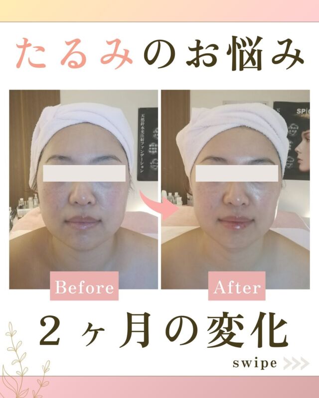 一
【立体小顔エステ結果写真】

立体小顔2ヶ月後のお写真です🪞💆‍♀️

30代モニター様。

お悩みだった
エラの張りや
頬のたるみが
すっきりして
小顔に✨✨

立体小顔エステは、
お顔だけではなく、
首や肩凝りもすっきり致します。

これからもどんどん小顔に🧏🏻‍♀️
年齢を重ねてもたるみが
気にならないようなお顔を
目指していきましょう💗

しっかりお手伝いさせていただきます！

お写真のご協力ありがとうございました。

∵∵∵∵∵ーーーーーーー∵∵∵∵ーーーーー∵∵∵∵

四日市市富田栄町84-1
ベレーザⅡ 102

小顔＆痩身専門サロン
SUQRAS サクラス

定休日▶︎毎週月曜、第2.4日曜
営業時間▶︎10時〜20時

＼あなたも変わってみませんか？／

☑︎エラが張って年々四角くなってきた
☑︎たるんで伸びた顔を引き上げたい！
☑︎二重アゴを何とかしたい！
☑︎色々やったけど効果がわからない
☑︎美容整形なしで変わりたい！

そんなあなたのためのサロンです♡

🔶痩せなくても-5kg見え！
🔶痛みゼロで気持ち良い施術
🔶リスクなしで整形級の効果
🔶ボディケアも兼ね備えた施術
🔶他のサロンで効果なかった方

【ご予約方法】
プロフィール下の公式LINEより
「予約」と一言入れて送信▶︎▶︎
Instagram→@suqras_kogao

※登録された時点ではこちらはどなたか分かりませんので
お気軽にご登録ください