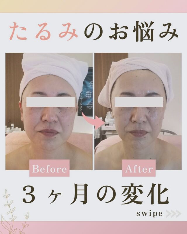 【立体小顔エステ結果写真】

立体小顔3ヶ月後のお写真です。
長年ご来店頂いております50代の
お客様♡

お悩みだった
エラの張りや
頬のたるみが
すっきりして
小顔に✨✨。

月2回のご来店でメンテナンスを
しっかりして頂いているので
本当にタルミのない小顔を
ずっーとキープしてもらっています♡

「同年代の女子会で並んで
写真撮った時に、他の人と
顔の大きさが全然違って嬉しい❣️
…と嬉しいお言葉ありがとうございます♪

立体小顔エステは、
お顔だけではなく、
首や肩凝りもすっきり致します。

これからもどんどん小顔に！
年齢を重ねてもたるみが
気にならないようなお顔を
目指していきましょう💗

しっかりお手伝いさせていただきます！
お写真のご協力ありがとうございました。

∵∵∵∵∵ーーーーーーー∵∵∵∵ーーーーー∵∵∵∵

四日市市富田栄町84-1
ベレーザⅡ 102

小顔＆痩身専門サロン
SUQRAS サクラス

定休日▶︎毎週月曜、第2.4日曜
営業時間▶︎10時〜20時

＼あなたも変わってみませんか？／

☑︎エラが張って年々四角くなってきた
☑︎たるんで伸びた顔を引き上げたい！
☑︎二重アゴを何とかしたい！
☑︎色々やったけど効果がわからない
☑︎美容整形なしで変わりたい！

そんなあなたのためのサロンです♡

🔶痩せなくても-5kg見え！
🔶痛みゼロで気持ち良い施術
🔶リスクなしで整形級の効果
🔶ボディケアも兼ね備えた施術
🔶他のサロンで効果なかった方

【ご予約方法】
プロフィール下の公式LINEより
「予約」と一言入れて送信▶︎▶︎
Instagram→@suqras_kogao

※登録された時点ではこちらはどなたか分かりませんので
お気軽にご登録ください